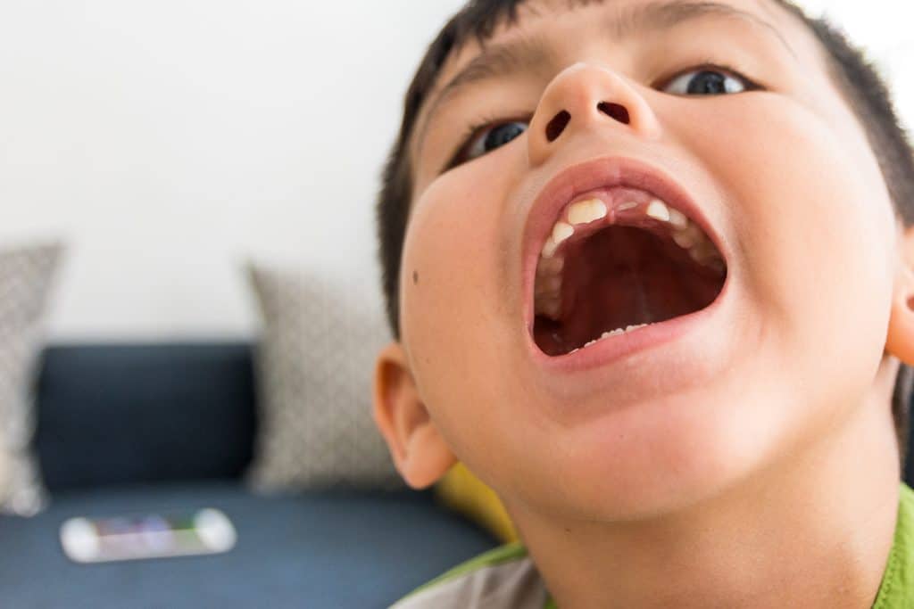 agenesia dentale bambino con bocca aperta