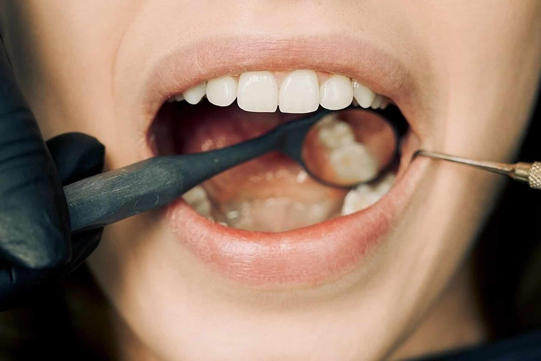 Macchiette bianche sui denti: cause e rimedi