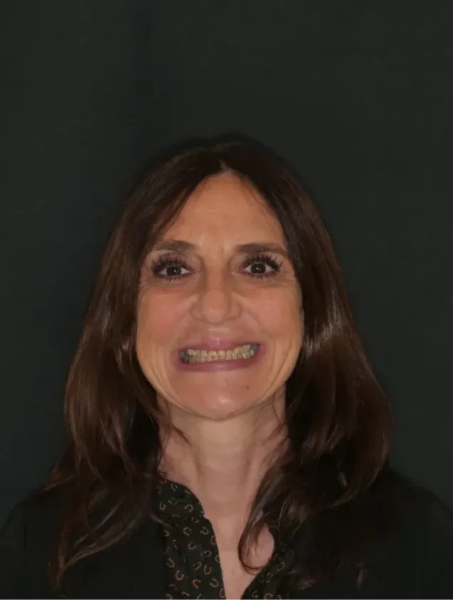 Faccette dentali VS Injection Technique: quale scegliere per migliorare il sorriso? 1 studio-bellemo-dentistico-pisa Frame 2147225936