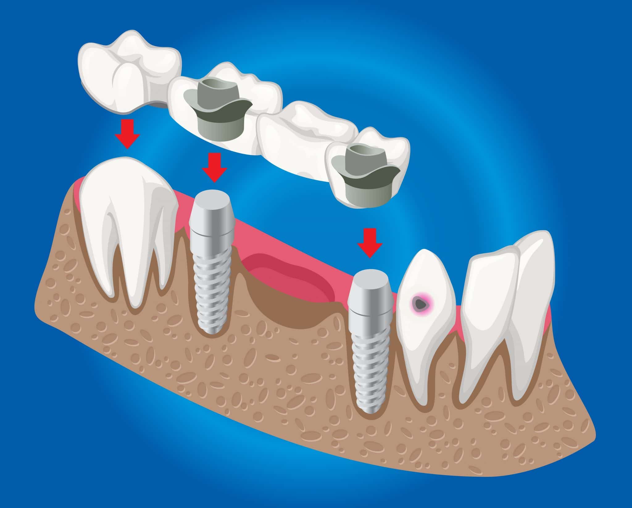 Se Uno Ingoia Un Ponte Dentale