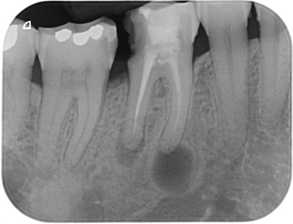 Endodonzia_protesi_prima