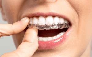 invisalign