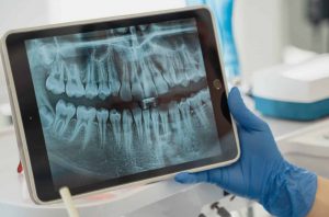 Un impianto dentale dolorante è una situazione spiacevole che rischia di peggiorare. Conoscere i sintomi è fondamentale per rivolgersi immediatamente al dentista e intervenire prima che possano peggiorare.