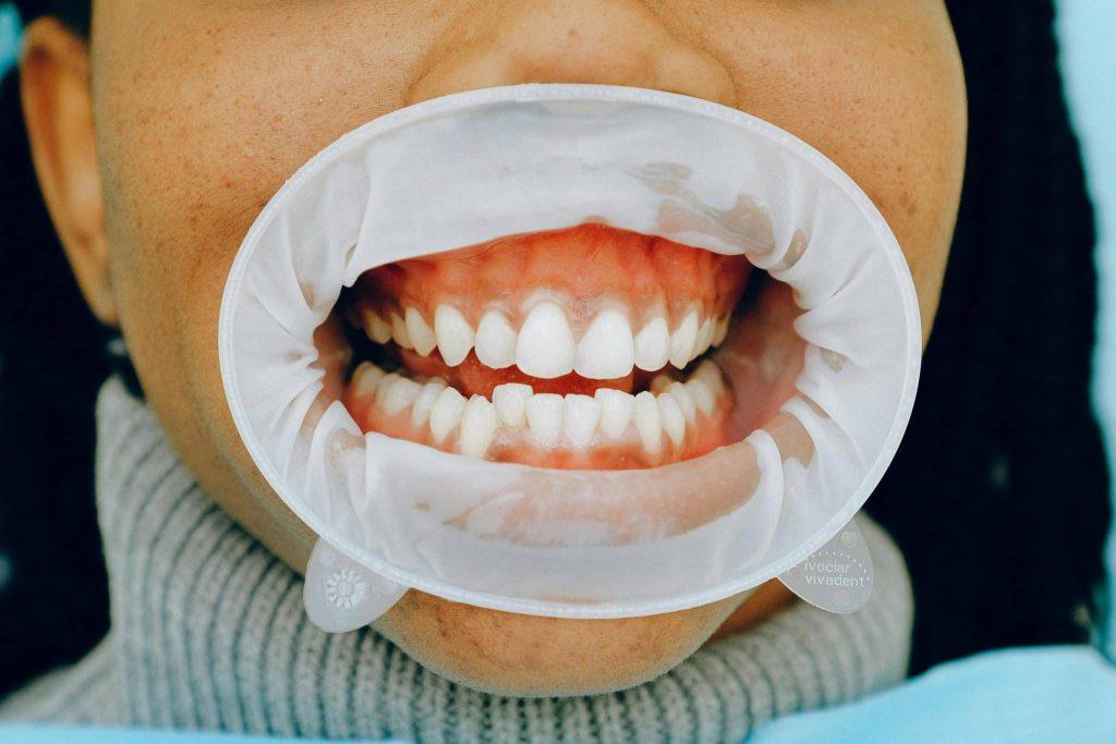 Colletti dentali scoperti? In questo articolo parliamo di prevenzione e trattamento di questa condizione delle gengive.