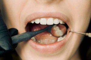 In questo articolo, parliamo di ascesso dentale, le cause, i sintomi, i trattamenti e gli antibiotici efficaci per la cura.
