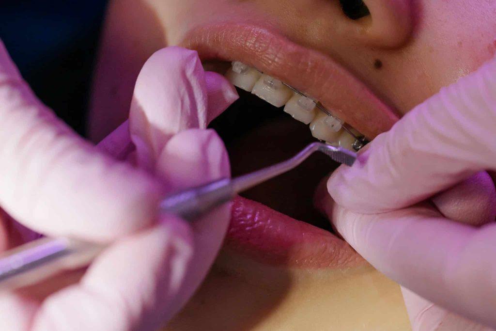 Questo articolo ha l'obiettivo di essere una guida alle varie tipologie di apparecchio denti. Vediamo insieme le loro caratteristiche.