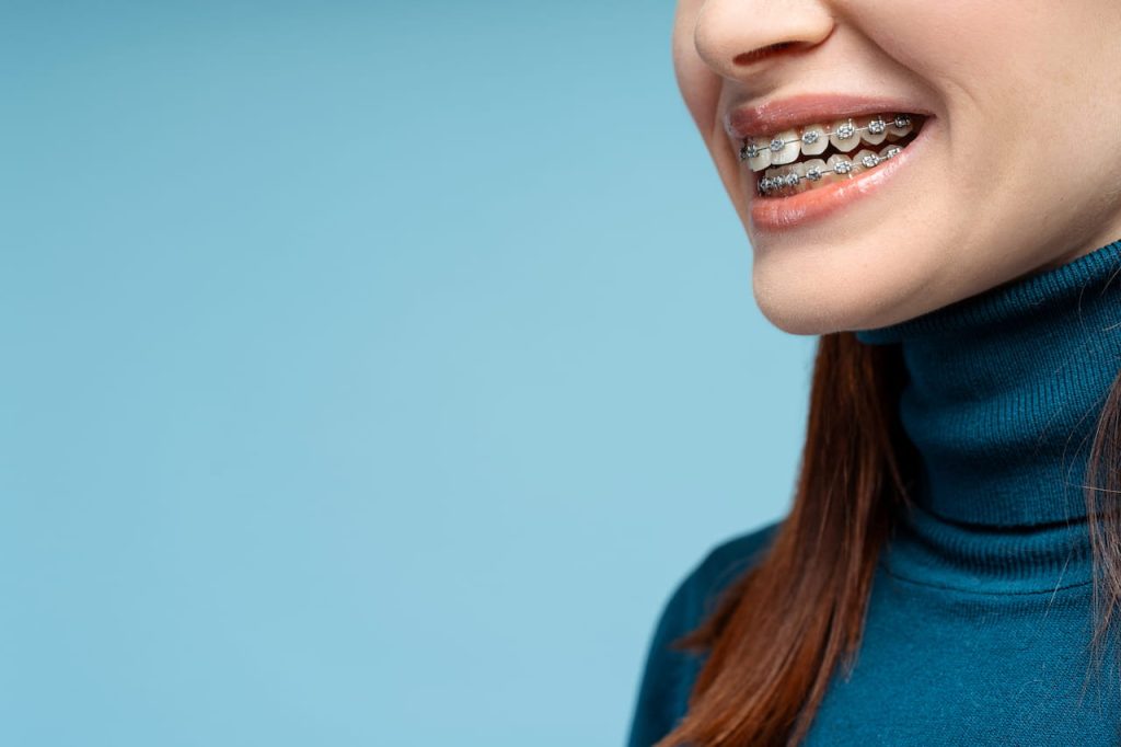 donna con apparecchio ai denti